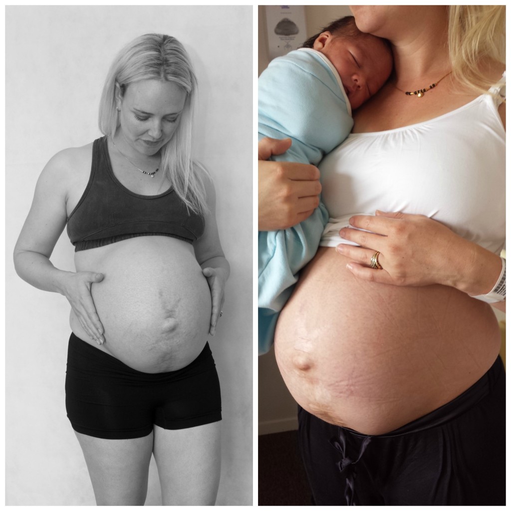 voor- en nafoto zwanger bevallen buik