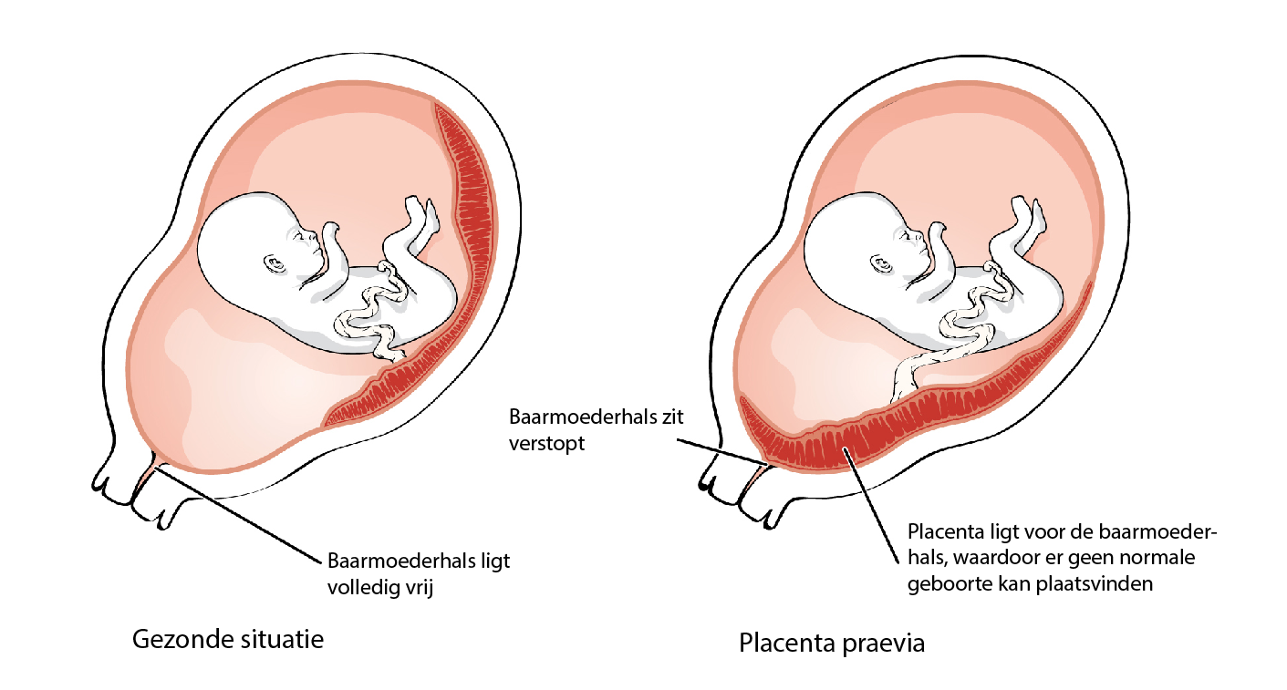 placenta praevia uitleg