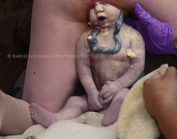 stuitligging foto bevalling