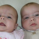 Tweeling wordt meer dan 5 weken na elkaar geboren