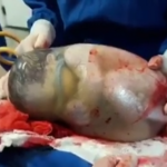 Zeldzame beelden: baby wordt geboren in vruchtzak